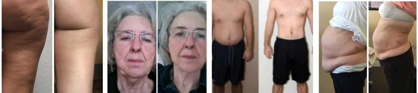 Before and After Photos of Red Light Therapy